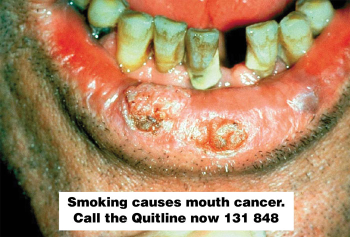 Image result for lip cancer pictures anti smoking ads